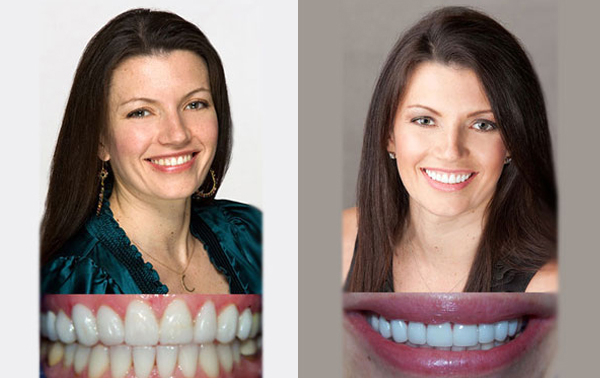 Cosmetic Dentist Stamford CT | Invisalign & Dental Implants