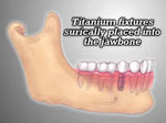 dental implants Stamford
