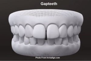 Invisalign for Gap Teeth