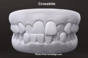 Invisalign braces help with crossbite