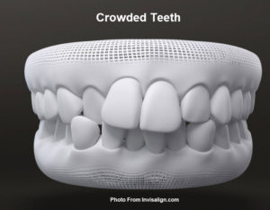 Invisalign braces for crowded teeth